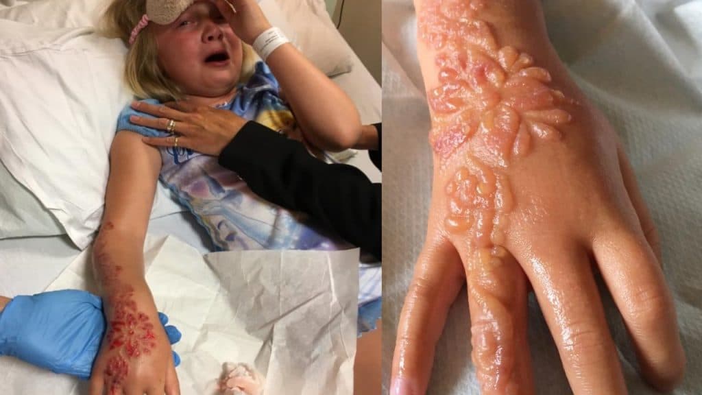 Происшествия: Семилетняя девочка получила химические ожоги после татуировки хной