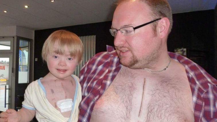 Общество: Отец в поддержку сына выжег на груди такой же шрам рис 2
