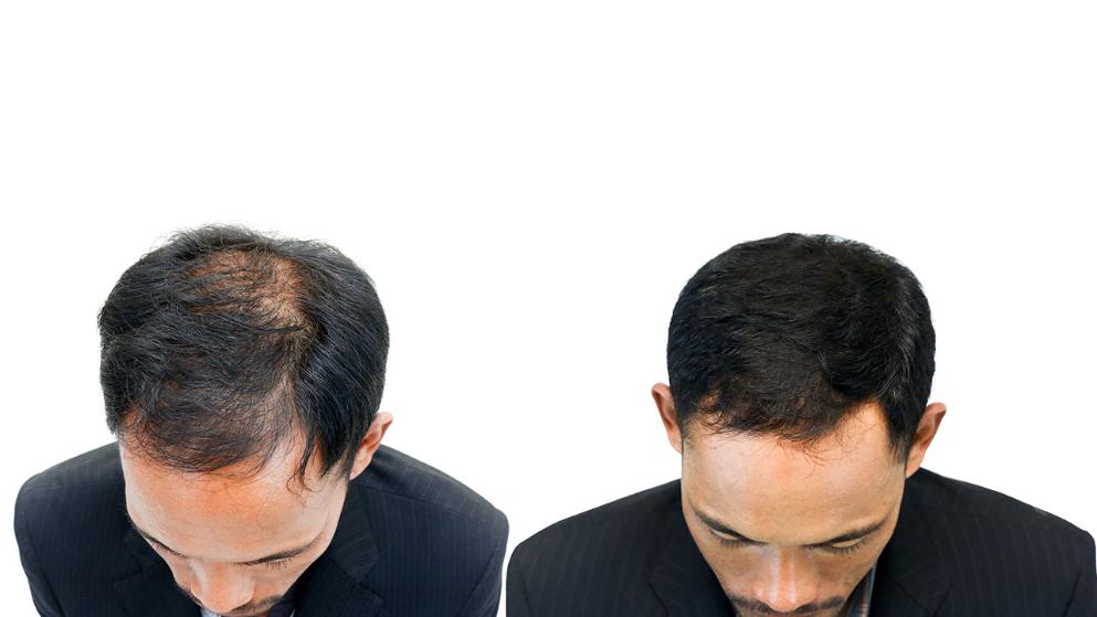 Здоровье: Как остановить выпадение волос: советы дерматолога