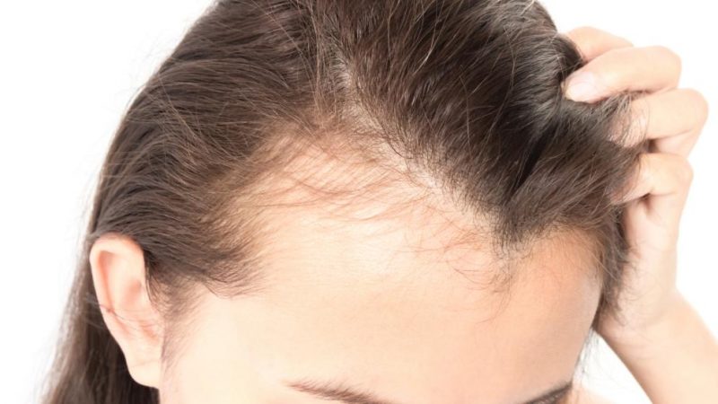 Здоровье: Выпадение волос у женщин: причины и что с этим делать