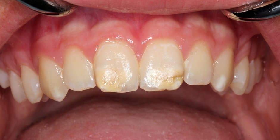 Здоровье: Стоматологи предупреждают: это заболевание поражает все больше детей