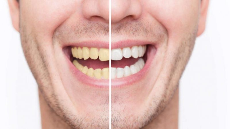 Здоровье: Желтые зубы: как устранить проблему?