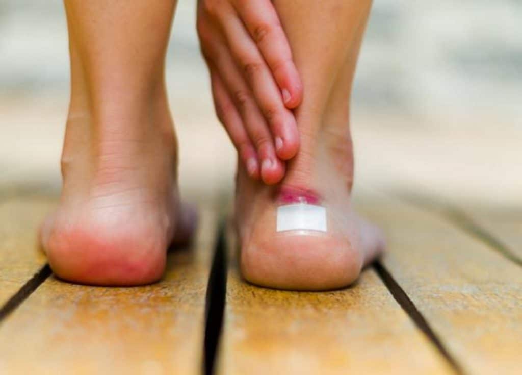 Здоровье: Мозоль на ноге: как быстро избавиться от недуга