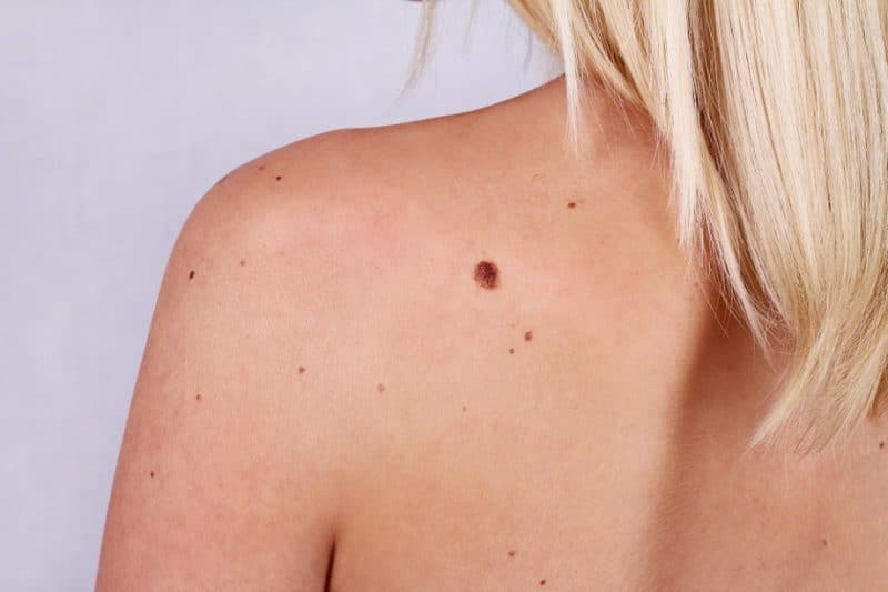 Здоровье: С помощью этих простых правил можно вовремя распознать рак кожи