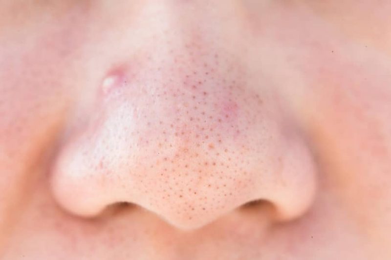 Здоровье: Герпес на кончике носа – первый признак опасной болезни