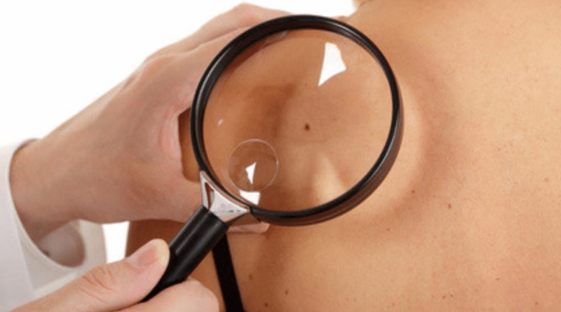Здоровье: Белый рак кожи: симптомы и способы лечения
