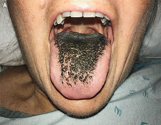 Здоровье: Из-за антибиотиков язык пациентки покрылся черной шерстью