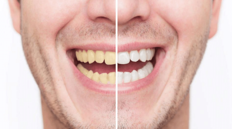 Здоровье: Желтые зубы: как решить проблему, не повредив эмаль?