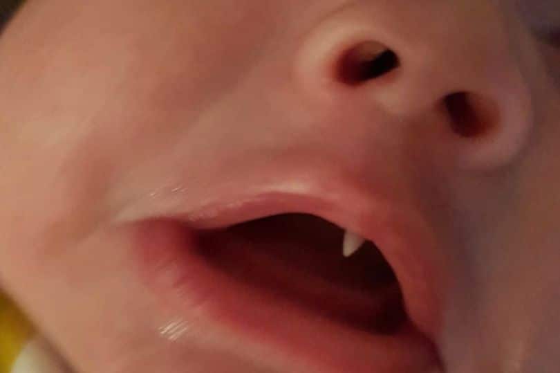 Досуг: Родители не поверили своим глазам: у трехмесячного малыша за ночь вырос клык