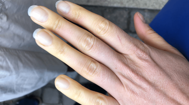 Полезные советы: Синеют и бледнеют пальцы на холоде? У вас может быть это заболевание