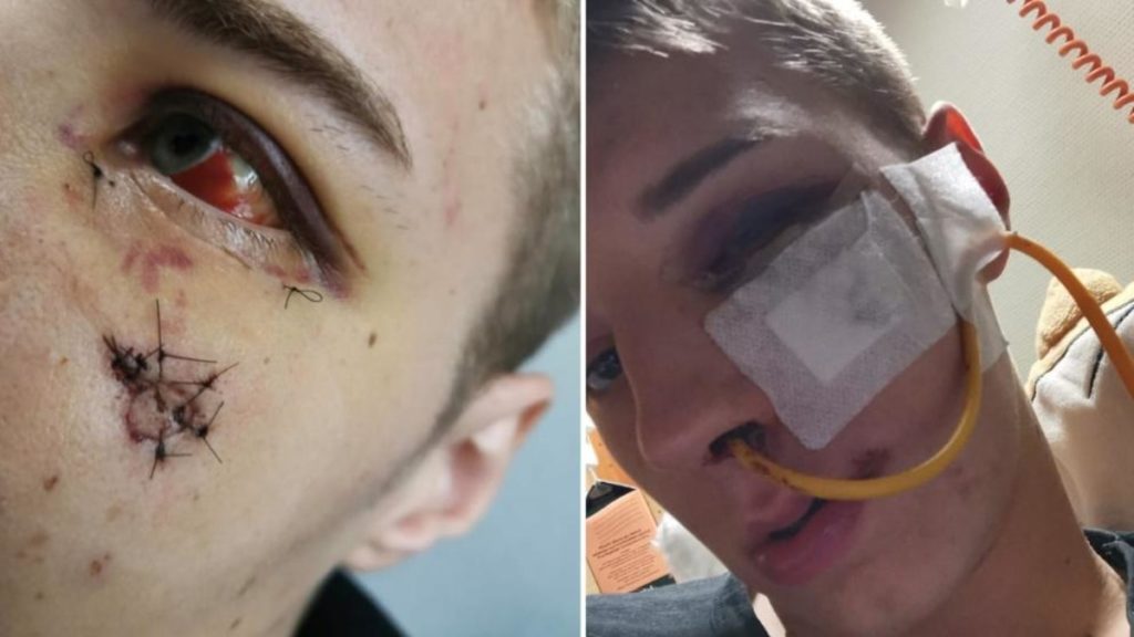 Общество: Саар: полицейский-стажер чуть не потерял глаз из-за выстрела в щеку