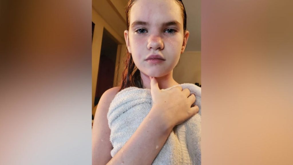 Отовсюду обо всем: Даже душ может стать для нее смертельным: у этой 12-летней девочки аллергия на воду
