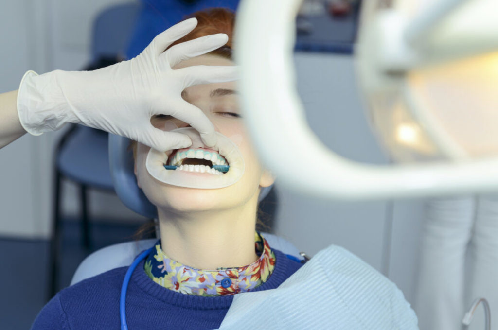 Здоровье: Сколько стоит отбеливание зубов в Германии и кто его оплачивает